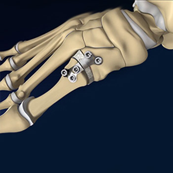 Foot Ankle Deformity Correction